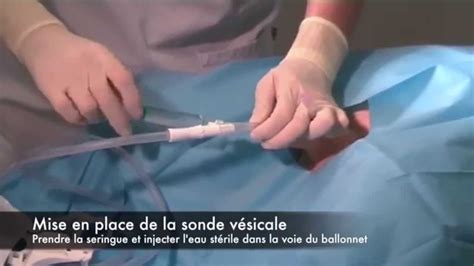 Sonde urinaire : pose, effets secondaires et retrait